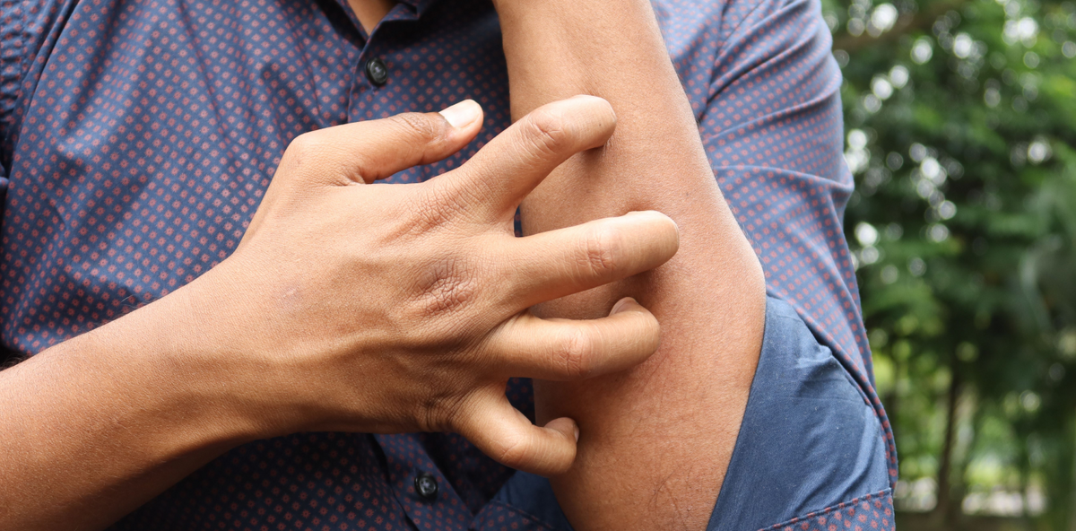 La Dermatite Seborroica: cos'è e come riuscire a gestirla